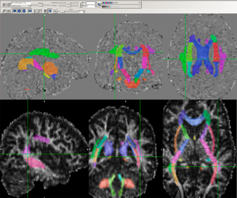 Diffusion tensor imaging of the brain.